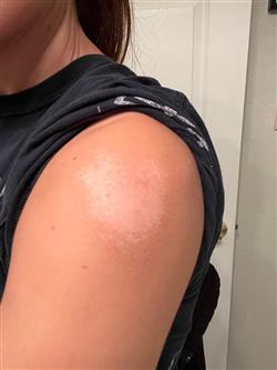 left shoulder scar.jpg