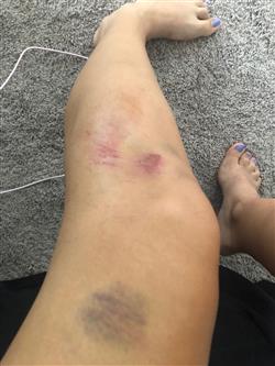left leg a few weeks later.jpg
