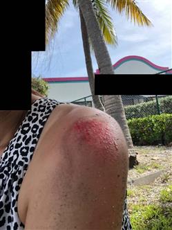 left shoulder_Redacted.jpg