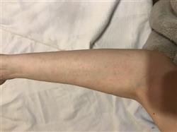 Fiberglass Cuts - Arm.JPG