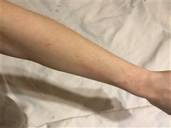 Fiberglass Cuts - Arm2.JPG